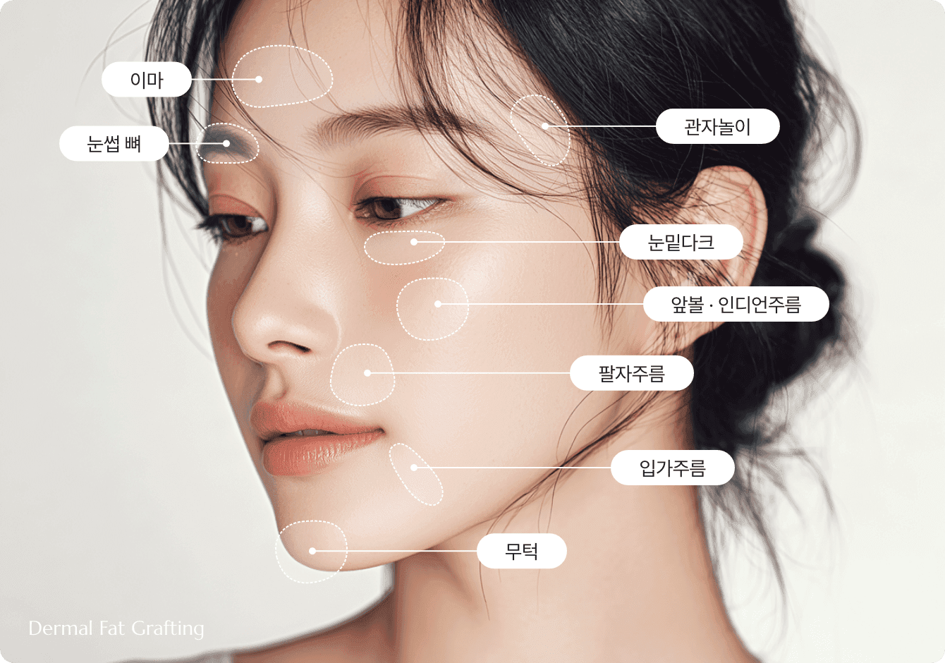 디마레 자가 진피지방이식, 깊게 패인 팔자주름이나 콧대 등 얇은 피부 부위에 본인의 진피 조직을 이식하여 이물감 없이 자연스럽고 영구적인 볼륨 형성