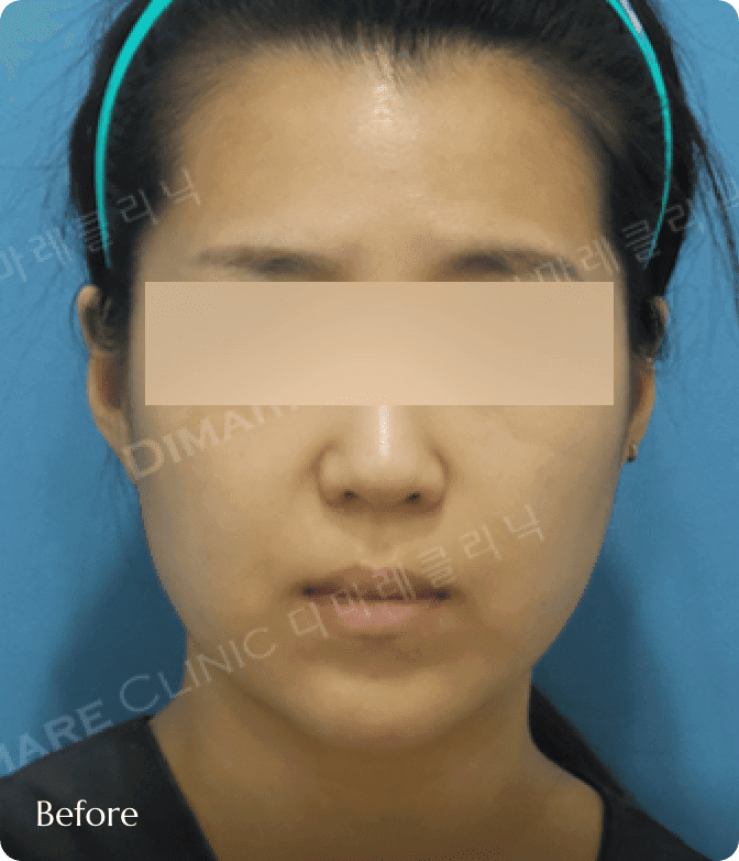 디마레 얼굴리프팅 시술 전, 깊은 팔자주름과 볼 살 처짐으로 인해 입가 주변에 그늘이 지고 나이 들어 보이는 노화 진행 상태