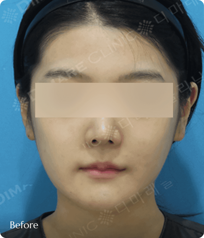 무너진 턱선과 심부볼 고민, 피부 탄력 저하로 인해 불독살이 늘어지고 얼굴과 목의 경계가 흐릿해진 리프팅 시술 전 모습