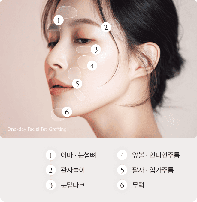 디마레 원데이(1day) 얼굴지방이식 시술 부위, 이마·관자놀이·눈밑·앞볼·팔자주름·무턱 등 꺼진 볼륨을 채워 입체적인 윤곽을 완성하는 디자인 포인트 설명