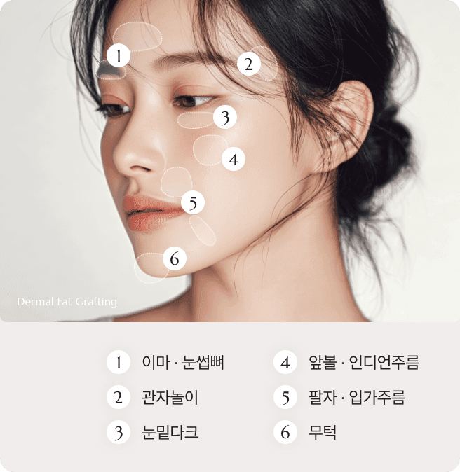 디마레 자가 진피지방이식, 깊게 패인 팔자주름이나 콧대 등 얇은 피부 부위에 본인의 진피 조직을 이식하여 이물감 없이 자연스럽고 영구적인 볼륨 형성