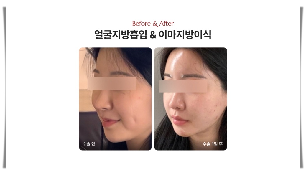 얼굴지방흡입 이마지방이식 시술 24시간 후 붓기 회복 전후 디마레클리닉