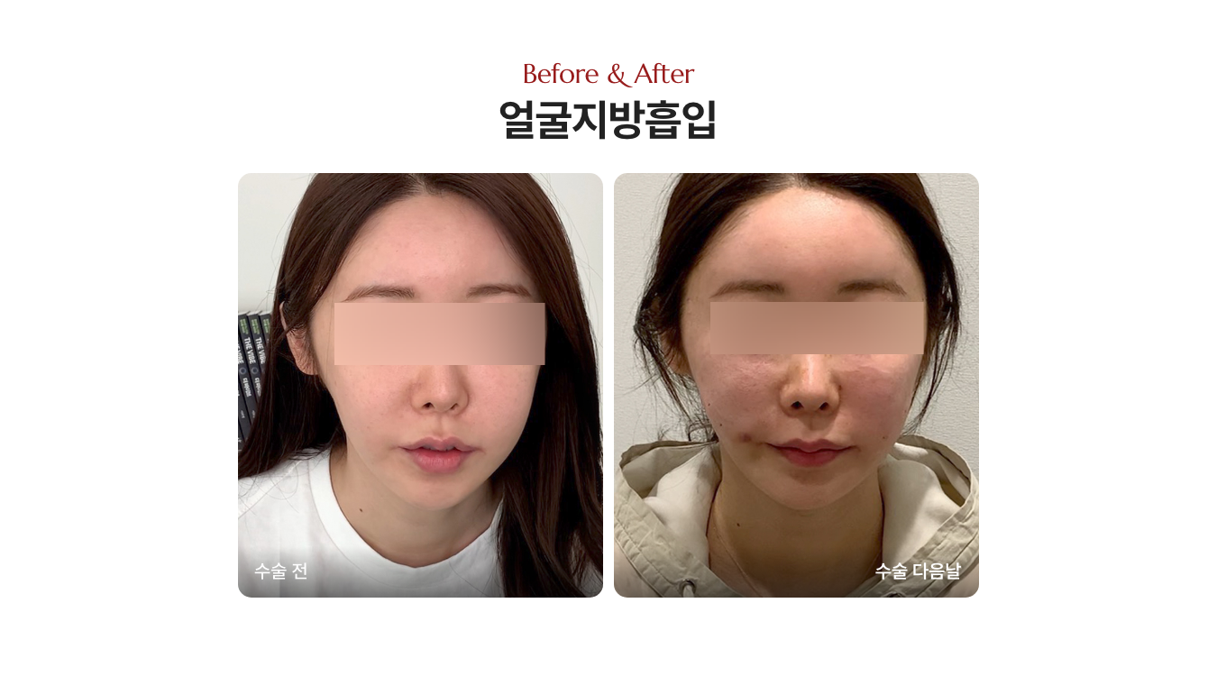 볼살 빼는 법 지방흡입 전후사진
