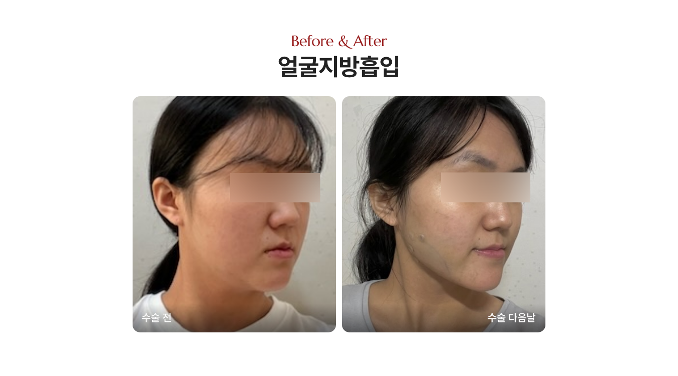 심부볼 제거 얼굴지방흡입 전후사진
