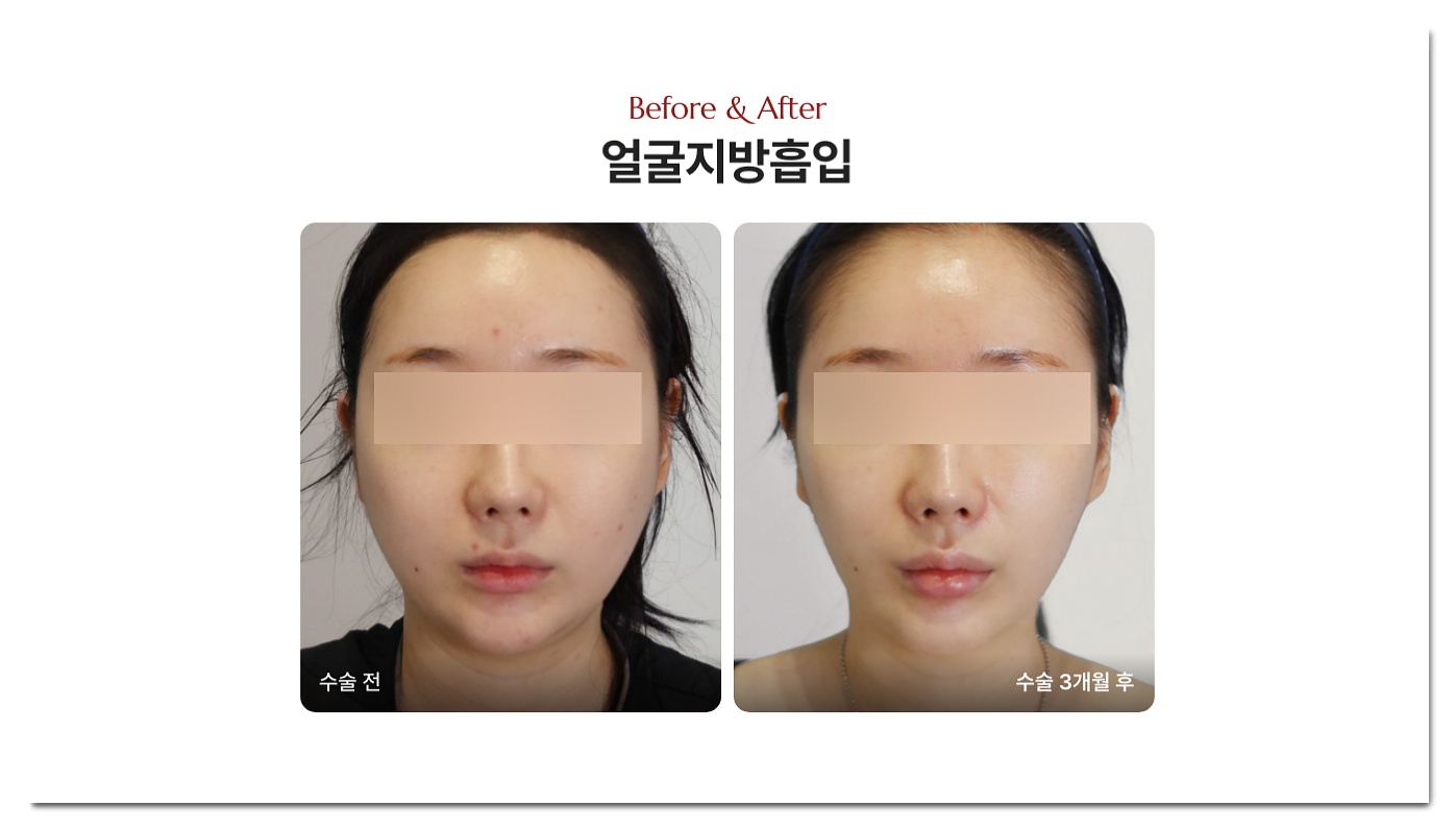 풀페이스 지방이식 후기 전후사진