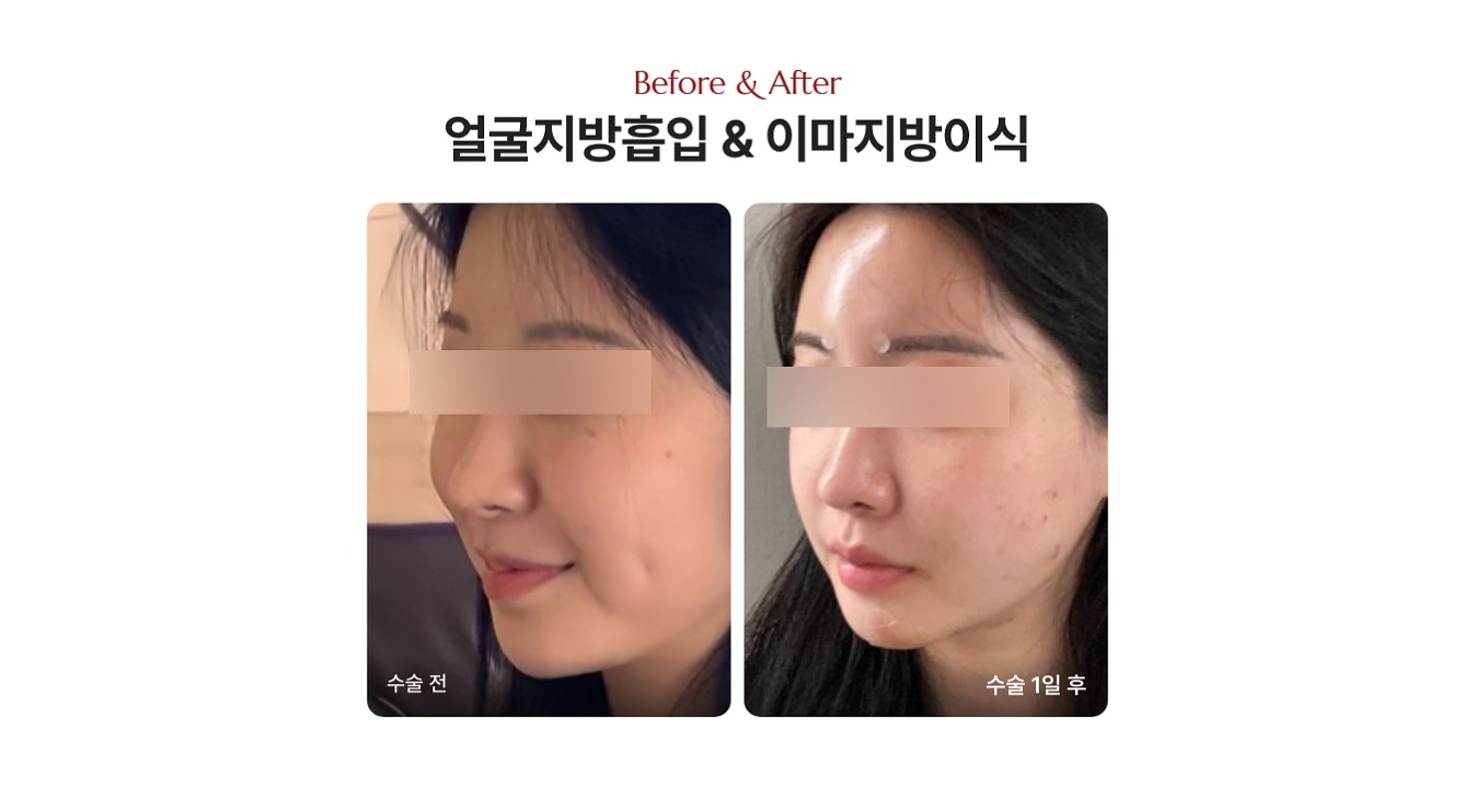 얼굴 지방이식 붓기 전후사진