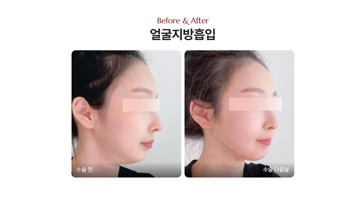 얼굴지방흡입 전후사진 디마레클리닉